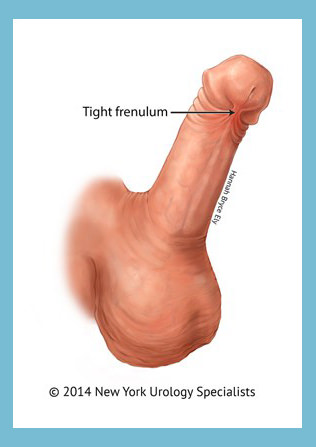 Penis frenectomy near me